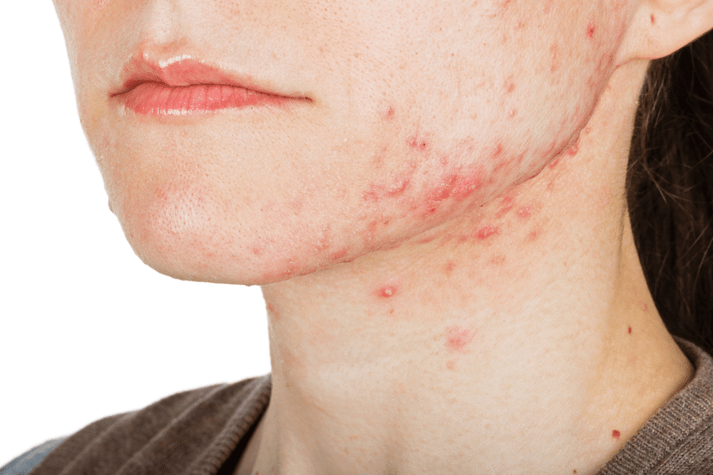 acne: skin disorder