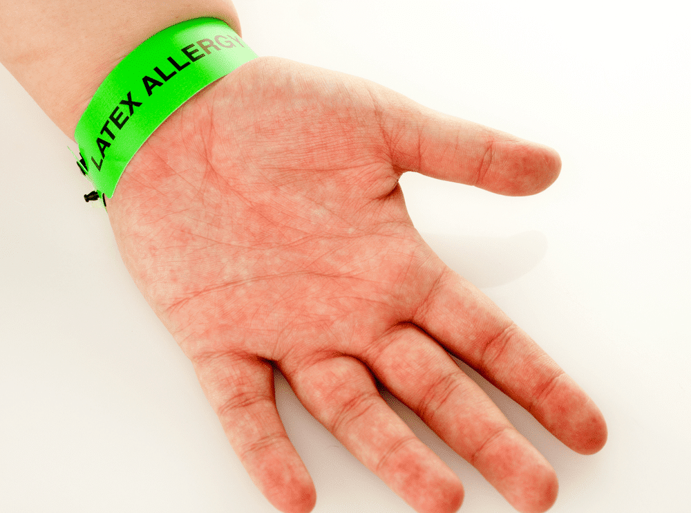 Latex allergy: skin disorder