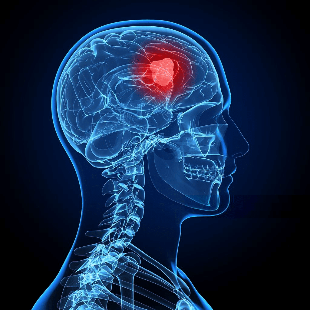 Brain tumor symptoms and causes - HealthZigZag