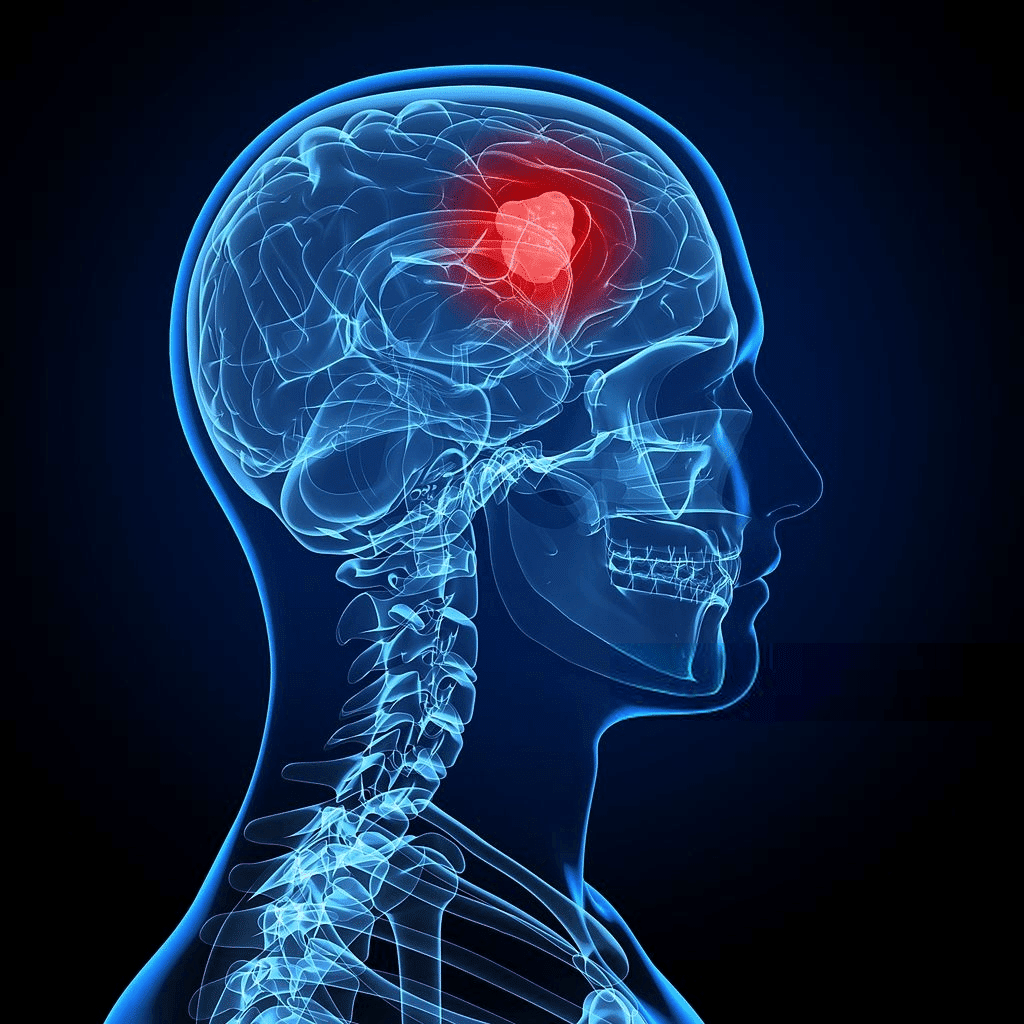 Brain tumor Symptoms and causes