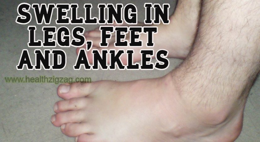 Swelling In Legs, Feet and Ankles – Causes, Symptoms and Treatment