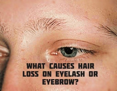What causes hair loss on eyelash or eyebrow?