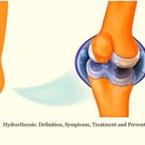 Hydrarthrosis: Definition, Symptoms, Treatment and Prevention