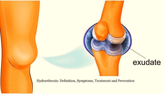 Hydrarthrosis: Definition, Symptoms, Treatment and Prevention