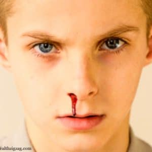 How to stop nose bleeding in a young child