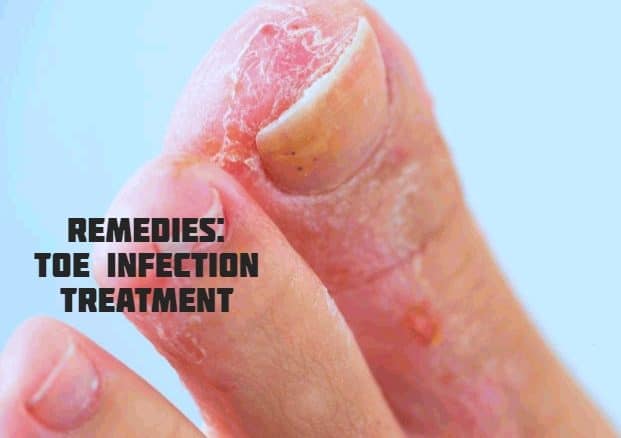 Remedies For The Treatment OF Toe Infection