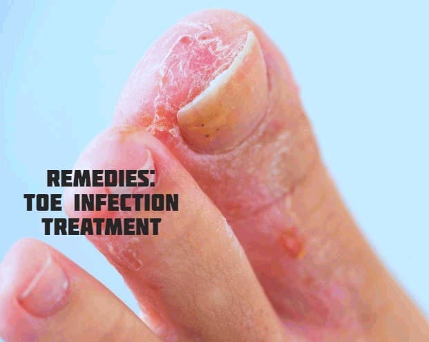 5 Remedies For The Treatment OF Toe Infection Www healthzigzag