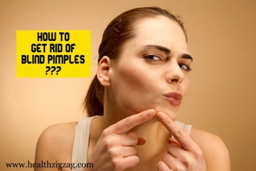 How To Get Rid Of Blind Pimples