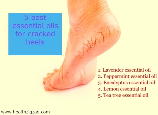 essential oil for cracked heels by healthzigzag