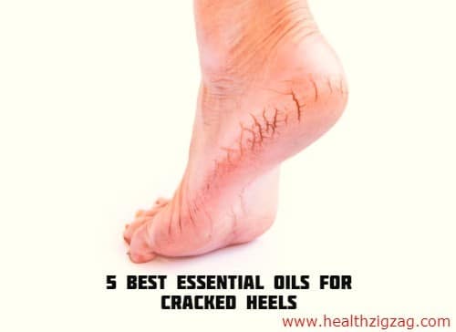 5 Best Essential Oils For Cracked Heels
