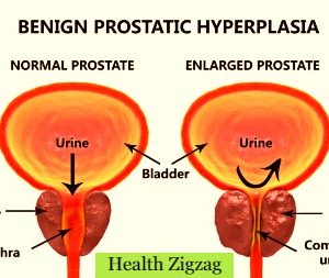 Facts to know about BPH and Benign Enlargement of Prostate gland