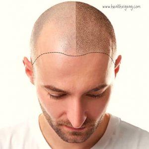 ALL YOU NEED TO KNOW BEFORE GETTٰٰING A HAIR TRANSPLANT
