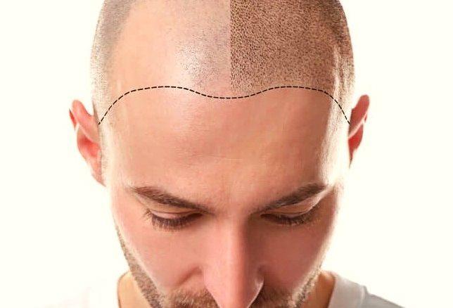 ALL YOU NEED TO KNOW BEFORE GETTٰٰING A HAIR TRANSPLANT
