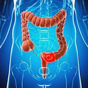 Diagnosis and Surgical Treatment of Colon Cancer