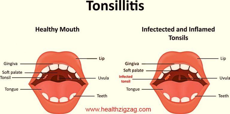 How to clean the tonsils? - www.healthzigzag.com - HealthZigZag