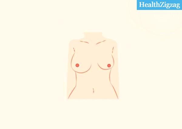 Asymmetric breasts