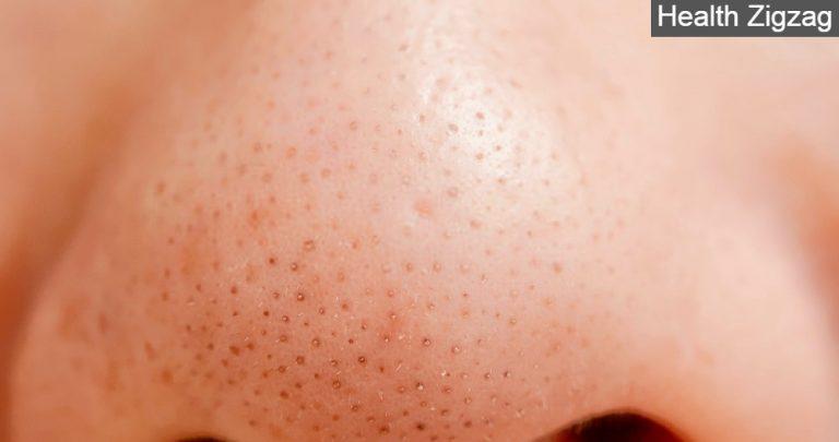 How to remove blackheads - www.healthzigzag.com