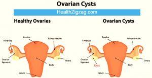 ovarian cyst ruptured