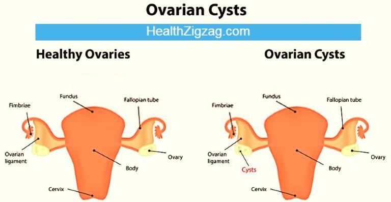 ovarian-cyst